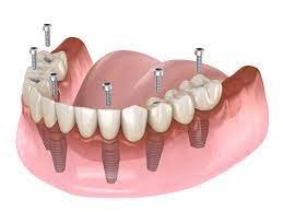 All-on-4 Dental Implant Today